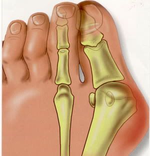 Bunions Callous